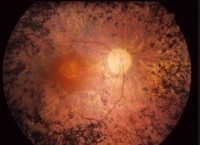 Imágen retina con retinosis pigmentaria